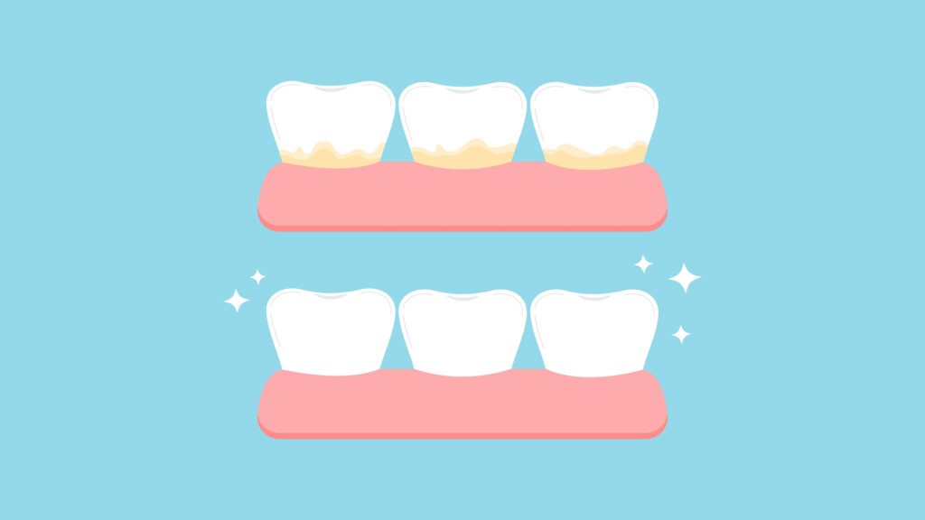 Zähne mit Ablagerungen und gesunde Zähne im Vergleich. Zahnstein erklärt.