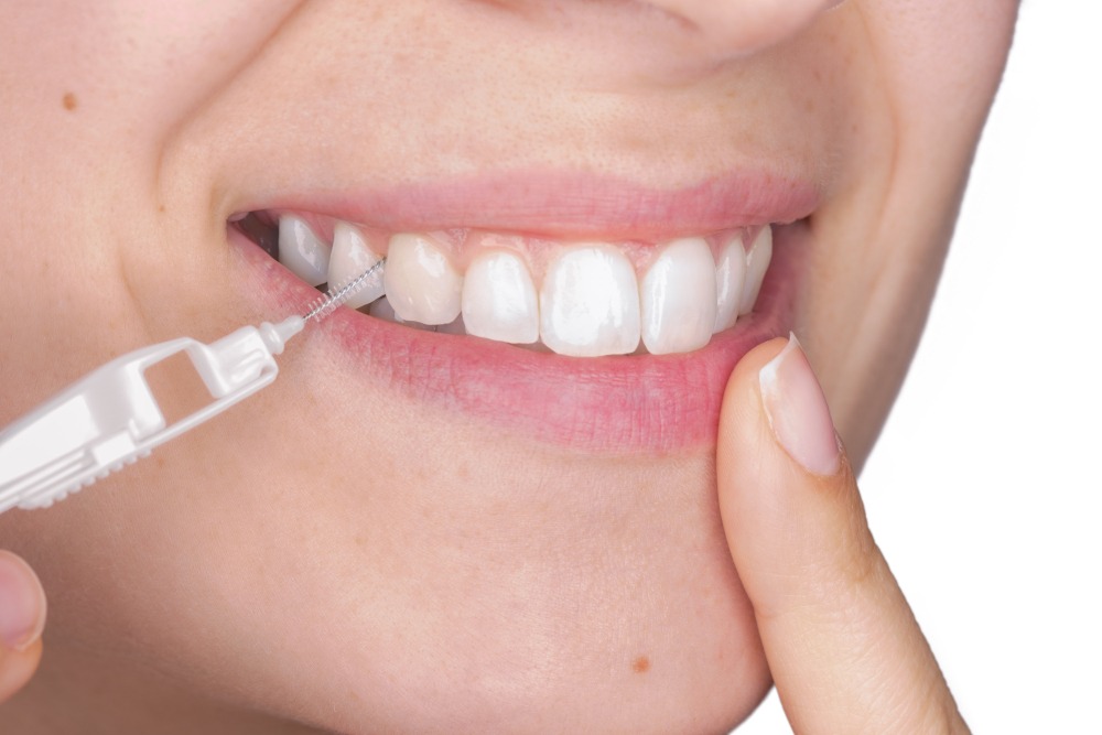 Zahnstein vorbeugen mit Zahnzwischenraumbürsten.
