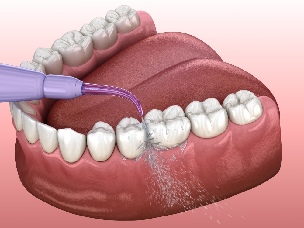 Munddusche reinigt enge Zahnzwischenräume. Prävention gegen Zahnstein.